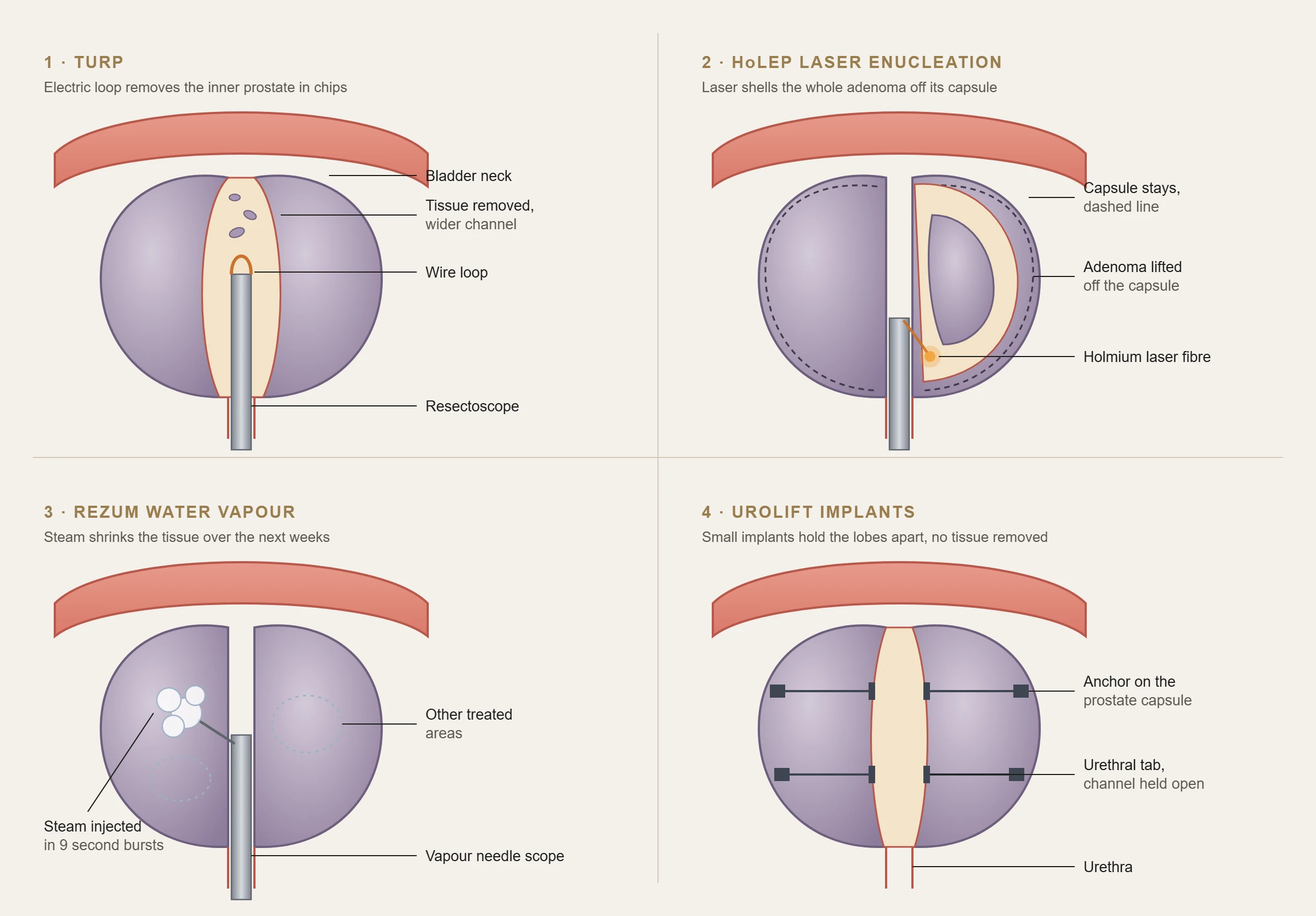 Labelled illustration of four enlarged prostate procedures: TURP removing the inner prostate with a wire loop, HoLEP laser lifting the adenoma off the capsule, Rezum steam injected into the prostate, and UroLift implants holding the lobes apart